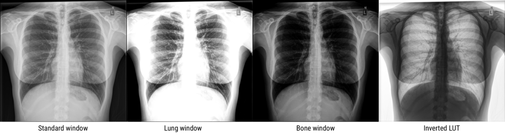 Chest x-ray with different windows and levels